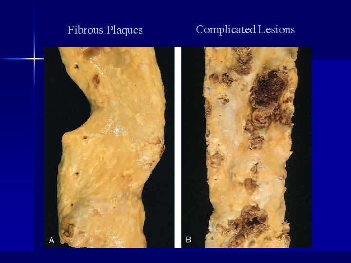 Fibrous Plaques Complicated Lesions 