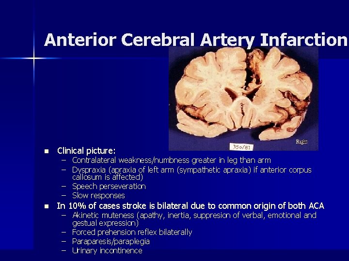 Anterior Cerebral Artery Infarction n Clinical picture: n In 10% of cases stroke is