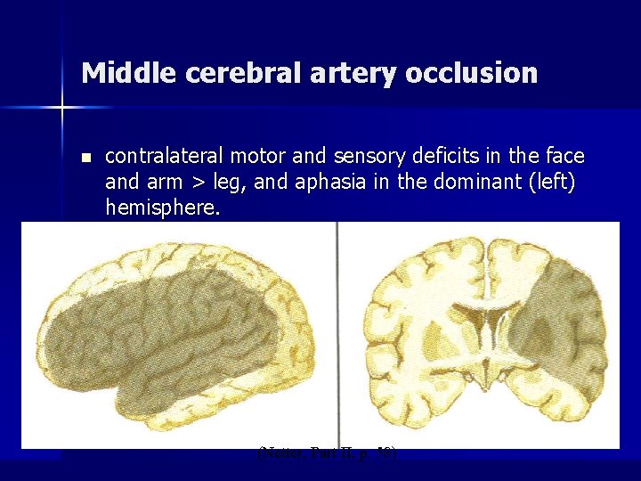 Middle cerebral artery occlusion n contralateral motor and sensory deficits in the face and