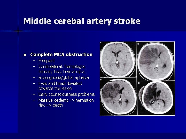 Middle cerebal artery stroke n Complete MCA obstruction – Frequent – Controlateral: hemiplegia; sensory