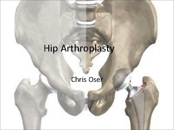 Hip Arthroplasty Chris Oser 