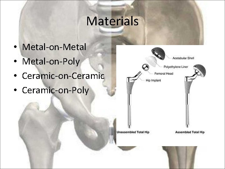 Materials • • Metal-on-Metal-on-Poly Ceramic-on-Ceramic-on-Poly 