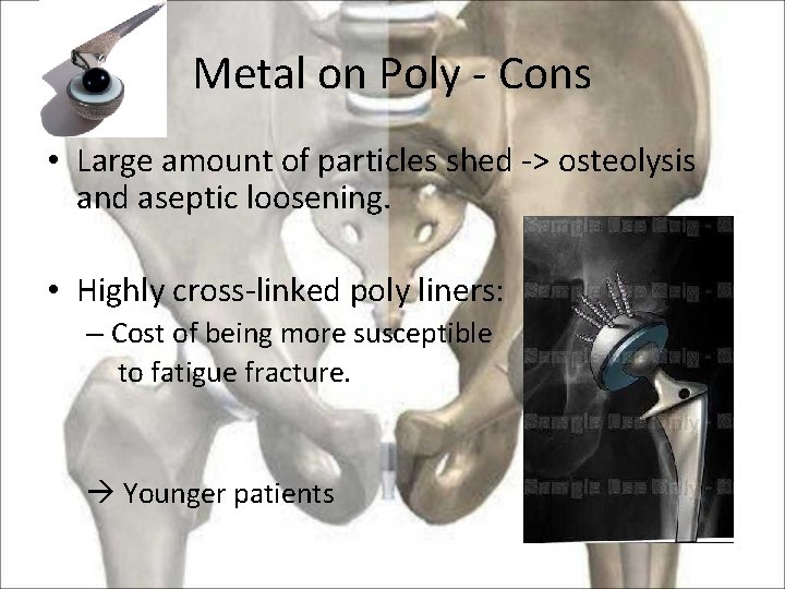 Metal on Poly - Cons • Large amount of particles shed -> osteolysis and