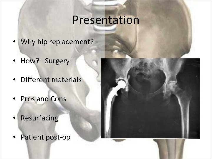 Presentation • Why hip replacement? • How? –Surgery! • Different materials • Pros and