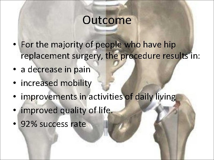 Outcome • For the majority of people who have hip replacement surgery, the procedure