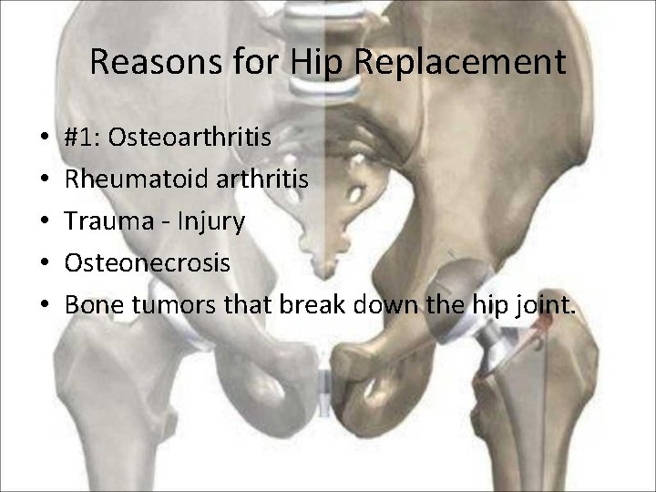 Reasons for Hip Replacement • • • #1: Osteoarthritis Rheumatoid arthritis Trauma - Injury