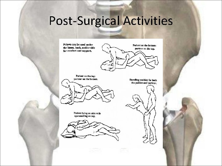 Post-Surgical Activities 