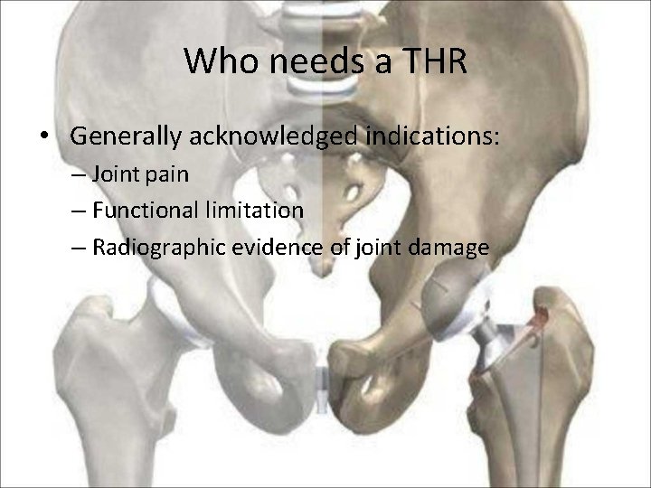 Who needs a THR • Generally acknowledged indications: – Joint pain – Functional limitation