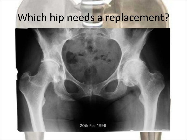 Which hip needs a replacement? 