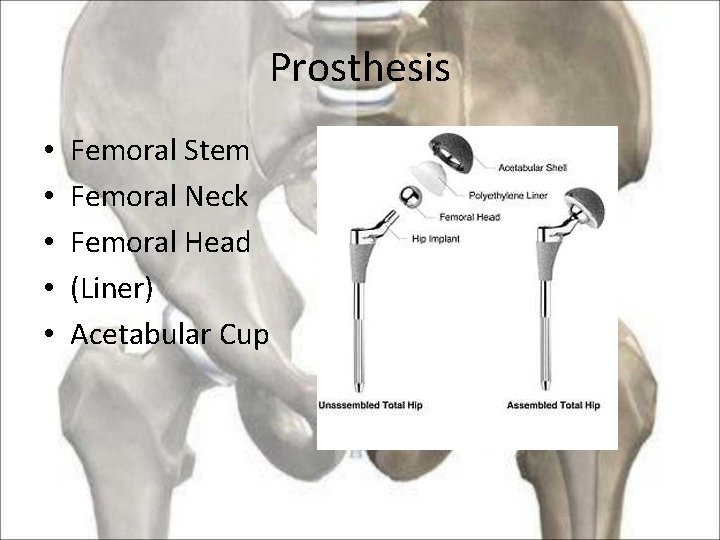Prosthesis • • • Femoral Stem Femoral Neck Femoral Head (Liner) Acetabular Cup 