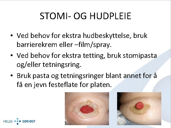 STOMI- OG HUDPLEIE • Ved behov for ekstra hudbeskyttelse, bruk barrierekrem eller –film/spray. •