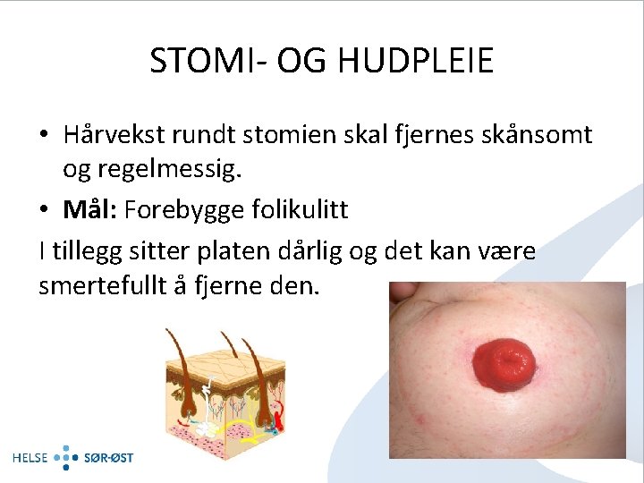 STOMI- OG HUDPLEIE • Hårvekst rundt stomien skal fjernes skånsomt og regelmessig. • Mål: