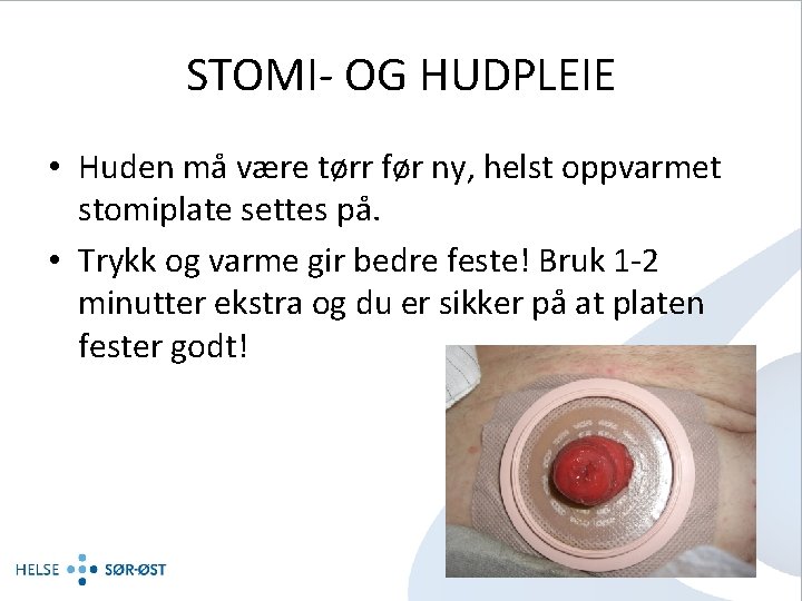 STOMI- OG HUDPLEIE • Huden må være tørr før ny, helst oppvarmet stomiplate settes