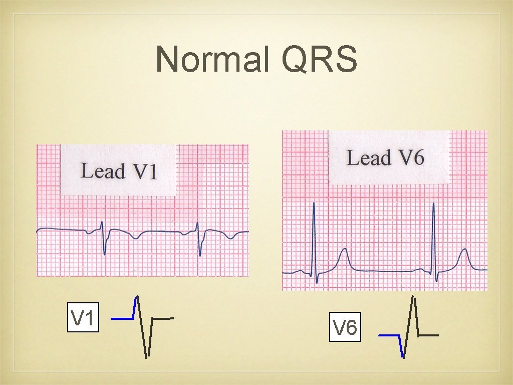 Normal QRS V 1 V 6 