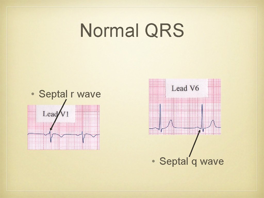 Normal QRS • Septal r wave • Septal q wave 