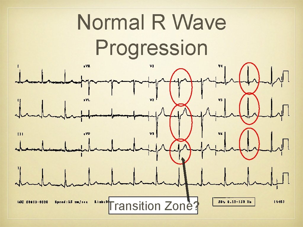 Normal R Wave Progression Transition Zone? 