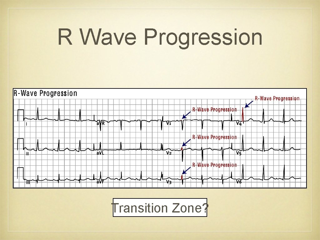 R Wave Progression Transition Zone? 
