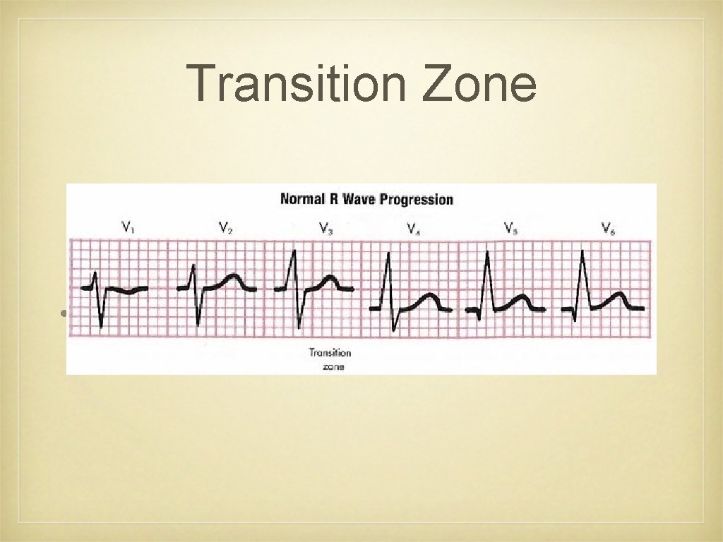 Transition Zone • Figure 4 -7 