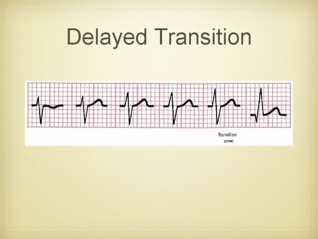 Delayed Transition • Figure 4 -7 