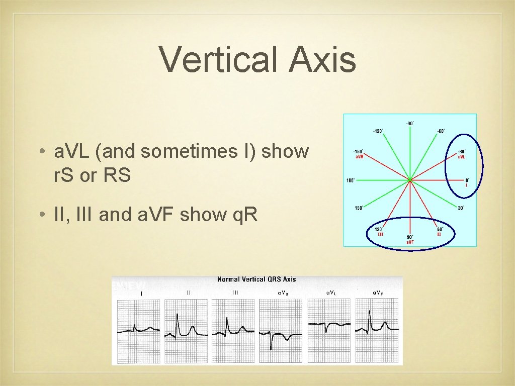 Vertical Axis • a. VL (and sometimes I) show r. S or RS •