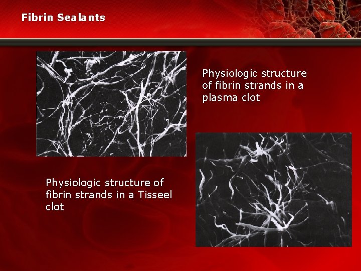 Fibrin Sealants Physiologic structure of fibrin strands in a plasma clot Physiologic structure of