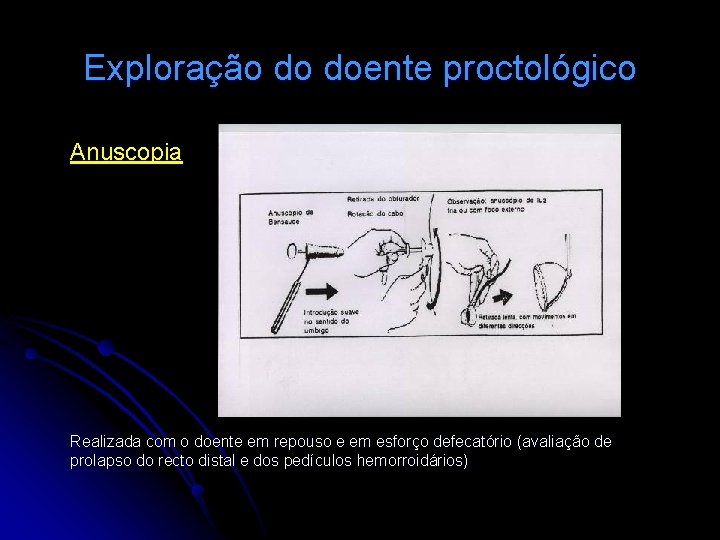 Exploração do doente proctológico Anuscopia Realizada com o doente em repouso e em esforço