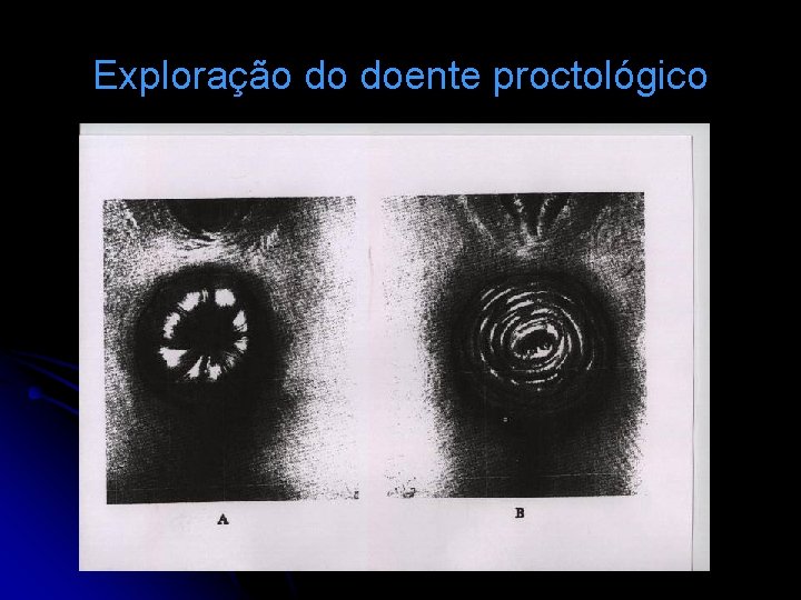 Exploração do doente proctológico 