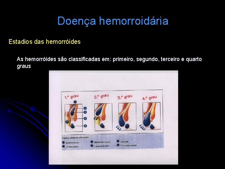 Doença hemorroidária Estadios das hemorróides As hemorróides são classificadas em: primeiro, segundo, terceiro e