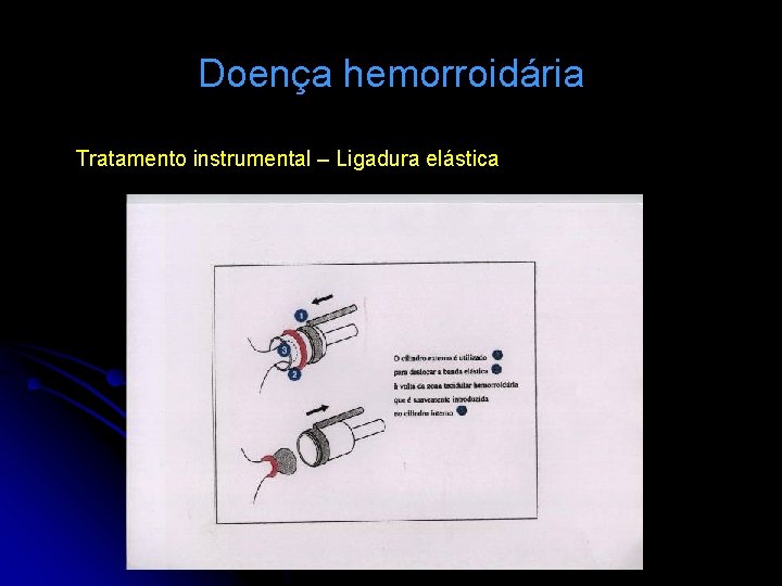 Doença hemorroidária Tratamento instrumental – Ligadura elástica 