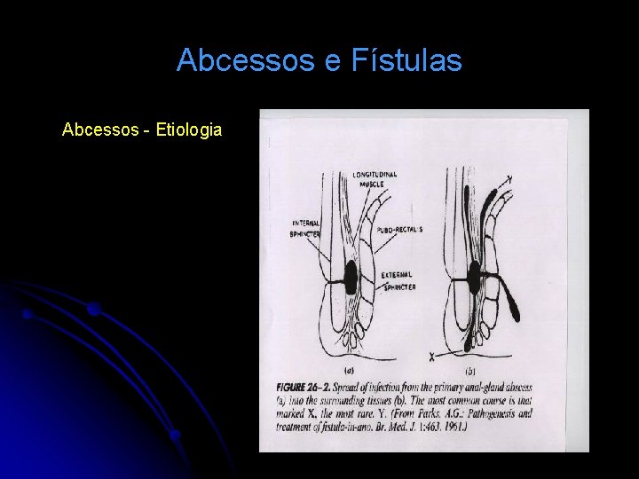 Abcessos e Fístulas Abcessos - Etiologia 