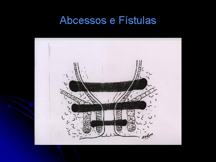 Abcessos e Fístulas 