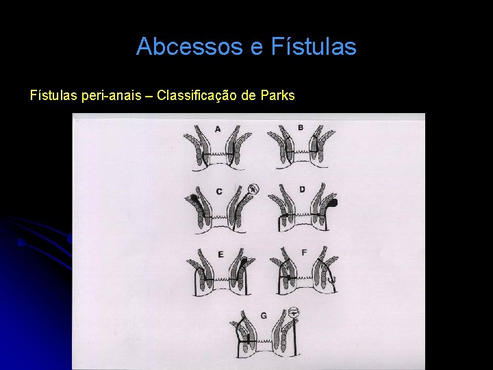 Abcessos e Fístulas peri-anais – Classificação de Parks 