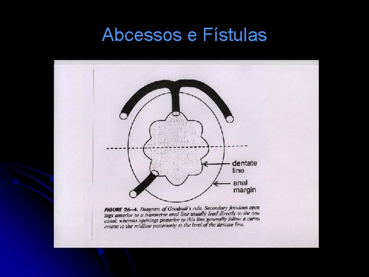 Abcessos e Fístulas 