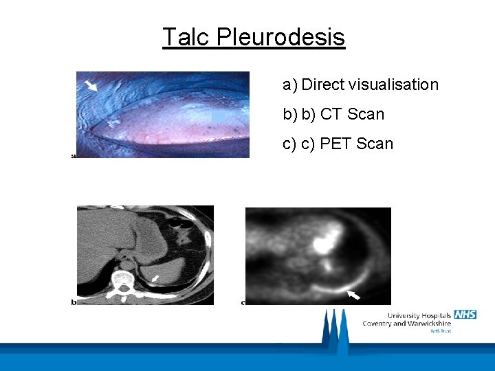 Talc Pleurodesis a) Direct visualisation b) b) CT Scan c) c) PET Scan 
