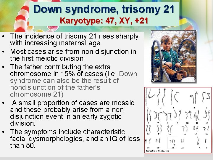 Down syndrome, trisomy 21 Karyotype: 47, XY, +21 • The incidence of trisomy 21