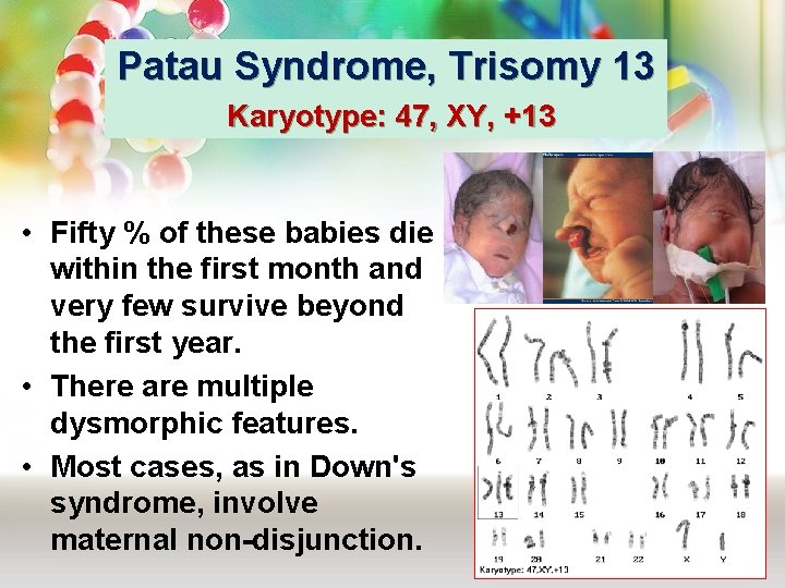 Patau Syndrome, Trisomy 13 Karyotype: 47, XY, +13 • Fifty % of these babies