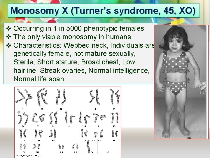 Monosomy X (Turner’s syndrome, 45, XO) v Occurring in 1 in 5000 phenotypic females