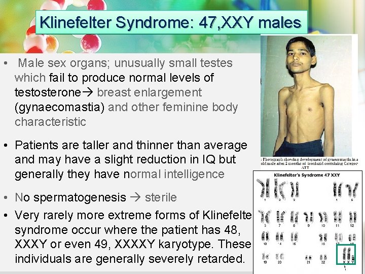 Klinefelter Syndrome: 47, XXY males • Male sex organs; unusually small testes which fail