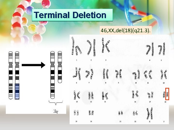 Terminal Deletion 46, XX, del(18)(q 21. 3). 