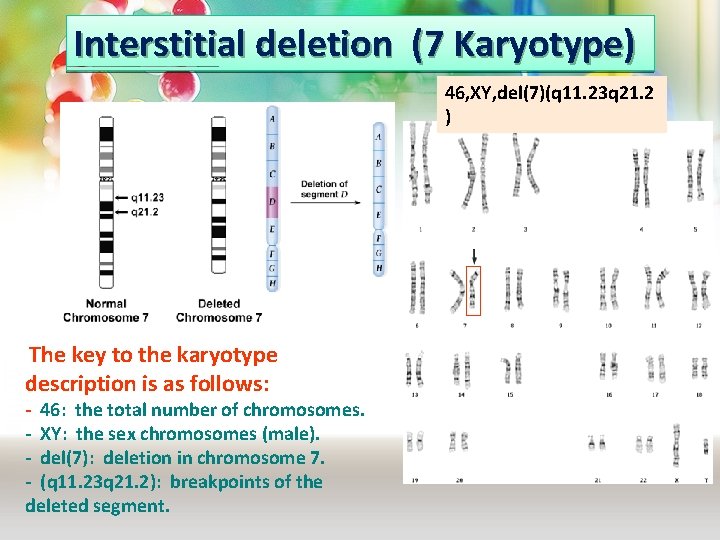 Interstitial deletion (7 Karyotype) 46, XY, del(7)(q 11. 23 q 21. 2 ) The