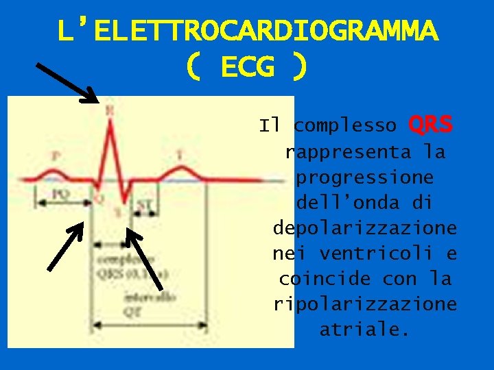 L’ELETTROCARDIOGRAMMA ( ECG ) Il complesso QRS rappresenta la progressione dell’onda di depolarizzazione nei