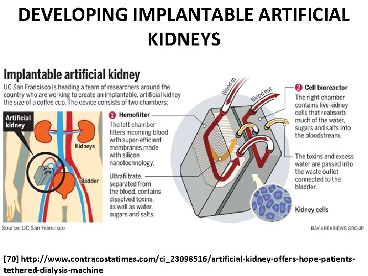 DEVELOPING IMPLANTABLE ARTIFICIAL KIDNEYS [70] http: //www. contracostatimes. com/ci_23098516/artificial-kidney-offers-hope-patientstethered-dialysis-machine 