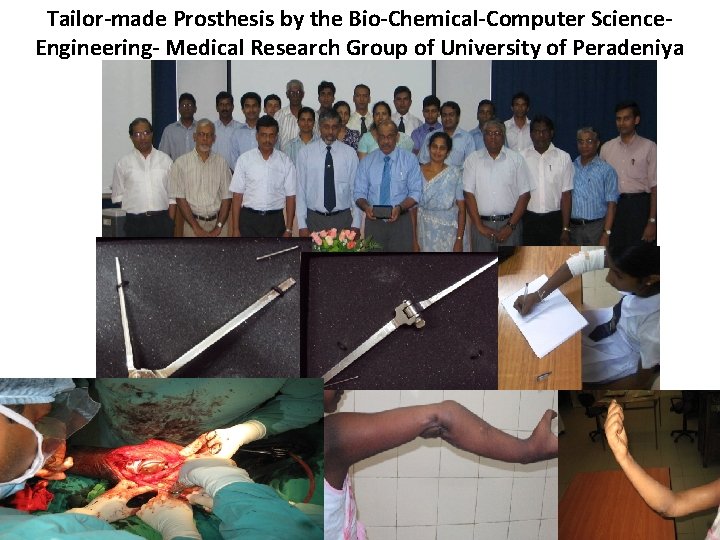 Tailor-made Prosthesis by the Bio-Chemical-Computer Science. Engineering- Medical Research Group of University of Peradeniya