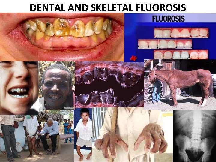 DENTAL AND SKELETAL FLUOROSIS 