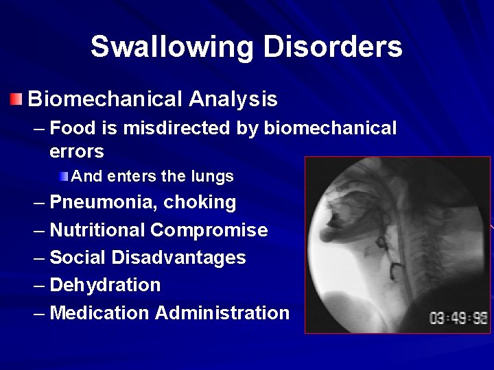 Swallowing Disorders Biomechanical Analysis – Food is misdirected by biomechanical errors And enters the