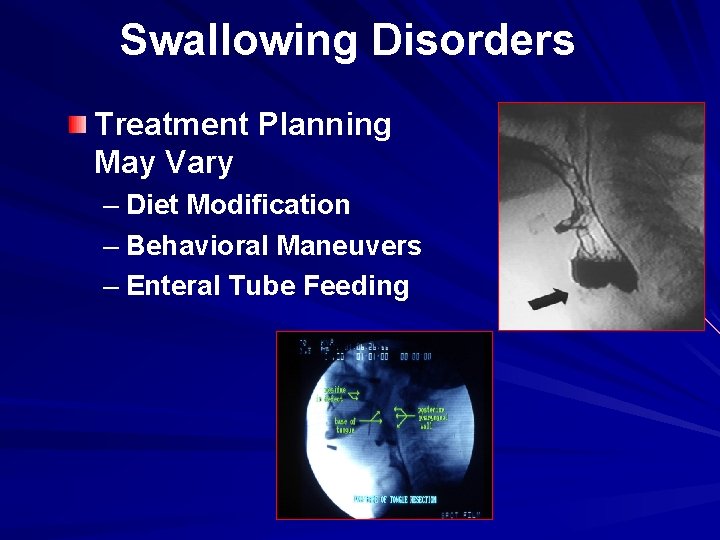 Swallowing Disorders Treatment Planning May Vary – Diet Modification – Behavioral Maneuvers – Enteral