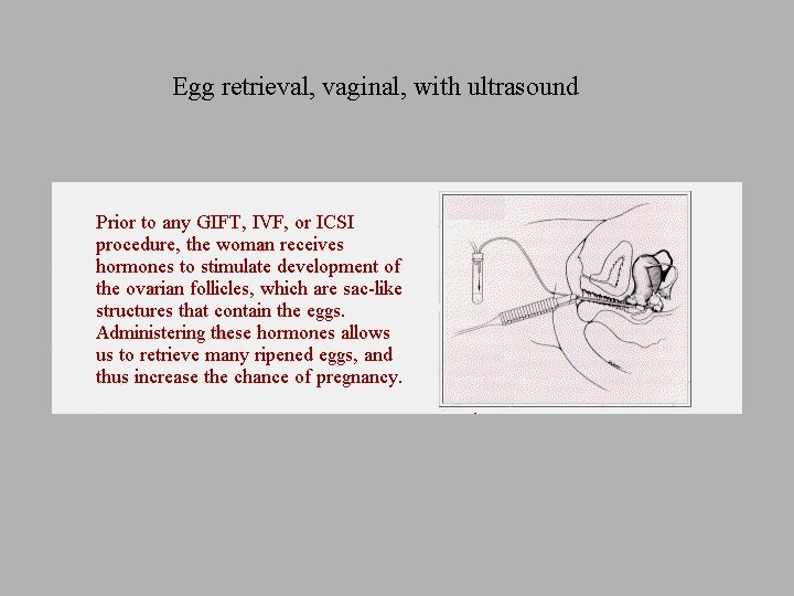 Egg retrieval, vaginal, with ultrasound 