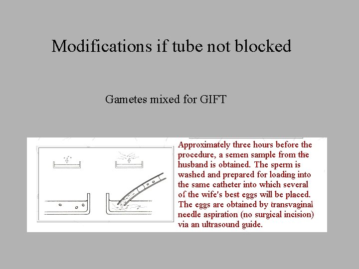 Modifications if tube not blocked Gametes mixed for GIFT 