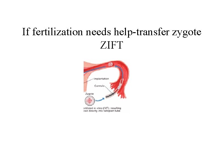 If fertilization needs help-transfer zygote ZIFT 