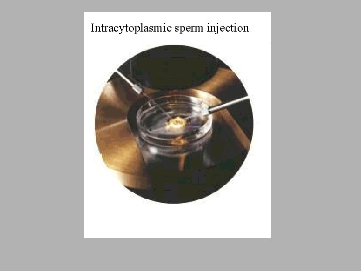 Intracytoplasmic sperm injection 